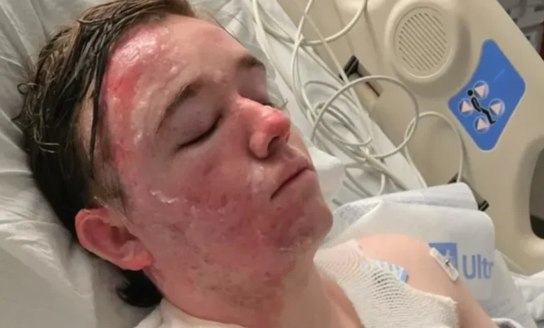 McDonald’s worker suffers severe burns on face and body after coworker throws hot oil on him, family says