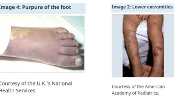 NL Health Services Advises of Meningococcal Disease Outbreak in Central Newfoundland