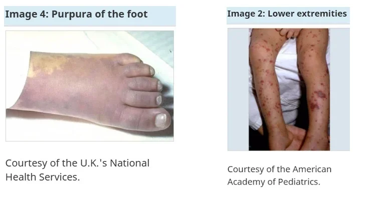 NL Health Services Advises of Meningococcal Disease Outbreak in Central Newfoundland