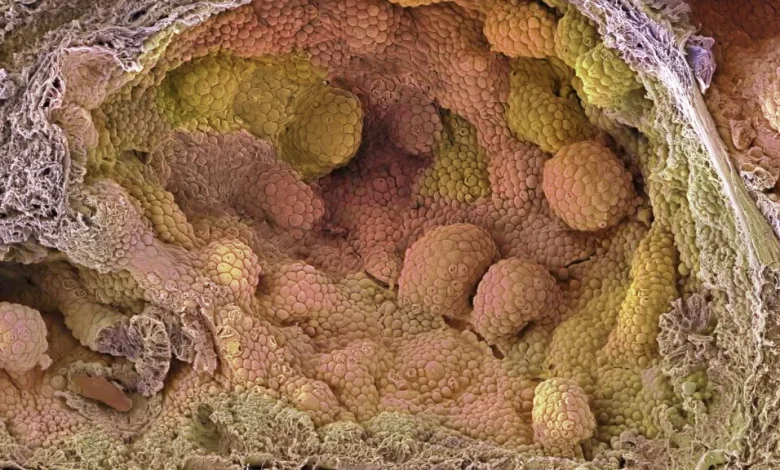 New hormone protocol cut relapse risk in prostate cancer trial